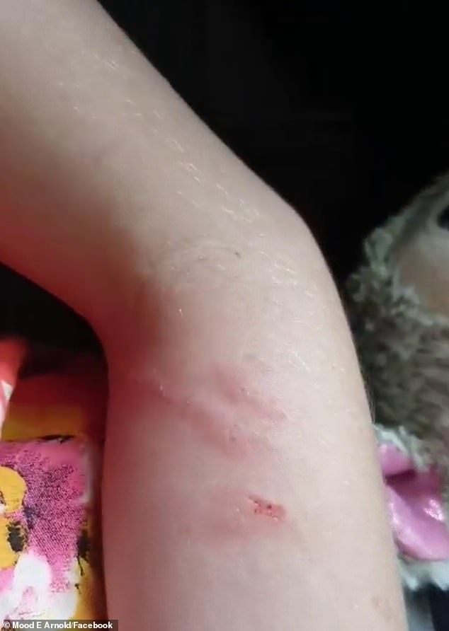 Майка показа раните от тормоз в училище над 12-годишната ѝ дъщеря с генетично заболяване (видео)